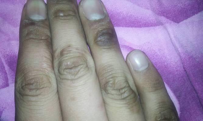 手被冰箱冻伤了怎么办？如何快速缓解疼痛并预防冻伤？